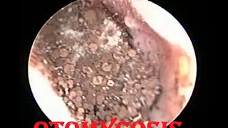 Severe fungal infection  Otomycosis ear cleaning [upl. by Maccarone]