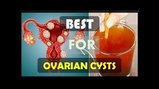 How To Get Rid Of Ovarian Cysts Naturally And Fast Home Remedies For Natural Treatment [upl. by Leroy]