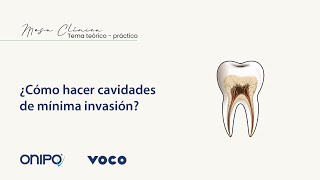 ¿Cómo hacer cavidades de mínima invasión [upl. by Yednarb60]