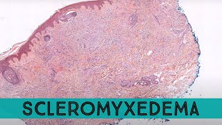 Scleromyxedema lichen myxedematosus NOT pretibial myxedema or scleromyxedema dermpath [upl. by Abdulla]