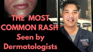 How to treat Perioral Dermatitis Dermatologist Explains [upl. by Tade]