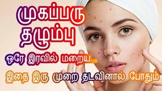 முகப்பரு மறைய  Pimple marks removal Homeremedies in Tamil Beauty Tips to remove pimples at Home [upl. by Kruger480]