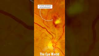 Hypertensive Retinopathy [upl. by Ennyroc]