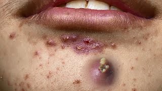 Big Cystic Acne Blackheads Extraction Blackheads amp Milia Whiteheads Removal Pimple Popping [upl. by Anada]