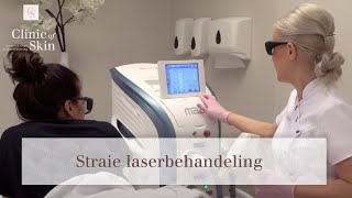 Striae laserbehandeling [upl. by Onailil]