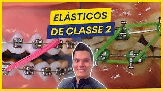 COMO TRATAR A CLASSE 2 COM ELÁSTICOS PASSO A PASSO [upl. by Thynne504]