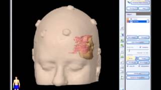 Removal of Brain Tumor Meningioma brain surgery [upl. by Hayse]