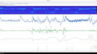 Scoring Sleep with ZMax  3 Sleep onset [upl. by Essilevi]