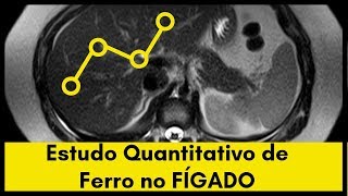 Estudo Quantitativo de Ferro Hepático na Ressonância Magnética [upl. by Aeneg]