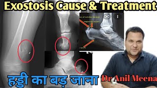 Exostosis Treatment  Exostosis cause and treatment  Osteochndroma  Osteophyte  Osteoma In Hindi [upl. by Neyu342]