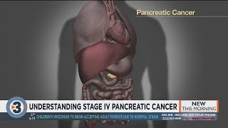 Understanding stage IV pancreatic cancer [upl. by Rednave986]