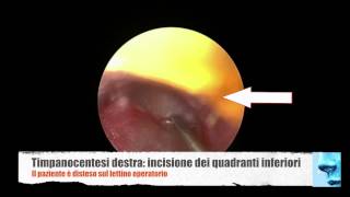 Otite media cronica glue ear aspirazione di secrezioni dalla cassa del timpano [upl. by Eicyac]