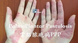 how to treat palmoplantar pustulosis psoriasis 掌跖脓疱病 PPP [upl. by Arymat]