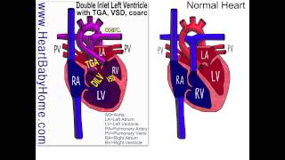 42 Double Inlet Left Ventricle with TGA vsd coarc [upl. by Ahsiened]