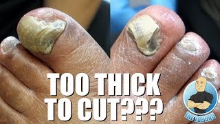 TRIMMING EXTREMELY THICK TOENAILS  FULL TREATMENT [upl. by Nosittam]