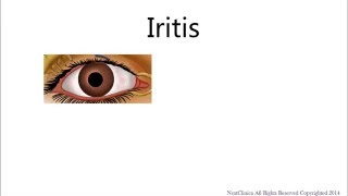 Iritis [upl. by Sari]