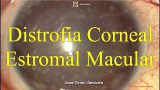 Distrofia Corneal Estromal Macular [upl. by Adav]