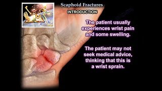 Scaphoid Fractures  Everything You Need To Know  Dr Nabil Ebraheim [upl. by Darbie]