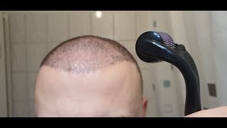 Minoxidil amp Dermarolling Results 6 MONTHS  Month by Month Progress [upl. by Bray292]