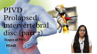 Stages of PIVD  Prolapsed intervertebral Disc  Hindi  Lecture Part 2  Slipped Disc Back Pain [upl. by Nodmac]