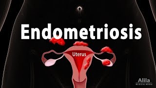 Endometriosis Pathology Symptoms Risk factors Diagnosis and Treatment Animation [upl. by Aticnemrac]