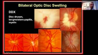 Approach to the Patient with Bilateral Optic Disc Swelling [upl. by Jacintha]