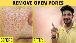 Remove Open Pores Very Fast Just 15mins Daily [upl. by Mian]