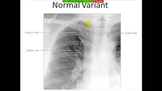 Radiological anatomy course  frcr  Chest video 2  Arabic edition [upl. by Eatnoid]