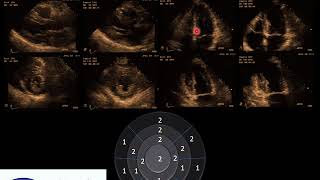 Ecocardiograma de contraste e estresse  Echo stress and contrast [upl. by Yrrej]