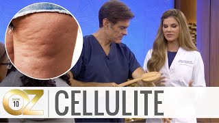 3 AtHome Cellulite Treatments [upl. by Asiar]