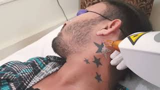 Laser Tattoo Removal at Nepalgunj Skin Center [upl. by Aselehc331]