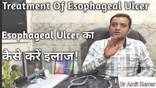 Esophageal Ulcer का कैसे करें इलाज  Treatment Of Esophageal Ulcer [upl. by Reivaxe847]