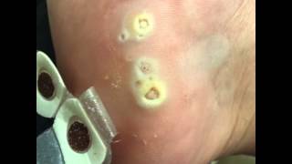 How to Remove Plantar Warts Naturally [upl. by Hassin]