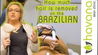 Is Laser Hair Removal Worth It  How Long Will It Last  Is It Safe [upl. by Xanthus237]