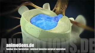 Herniation quotlumbarquot Treatment Surgery 3D Animation [upl. by Eiramannod667]