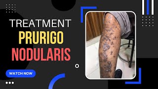 Prurigo Nodular Eczema Treatment ITCHY Skin bump एक्जिमा इलाज Dr Uttam Lenka [upl. by Teerell]