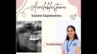 Ameloblastoma01  Easiest Explanation  Oral Pathology  BDS [upl. by Fenwick]