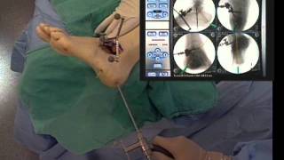 Ankle Surgery Subtalar Arthrodesis [upl. by Llenrub]