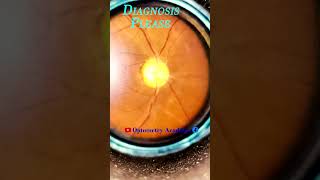 Membrane at Disc  Diabetic Retinopathy  Fundus Videography  Fundus Photography  Short Video 80 [upl. by Lorrac]