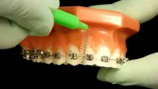 Bracesquestionscom  Brushing With Braces How to Brush Teeth [upl. by Lekcar]