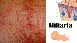 Miliaria Heat Rash  Types Causes Signs amp Symptoms amp Treatment [upl. by Henson380]