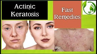 Actinic Keratosis Dermatology [upl. by Zetana723]