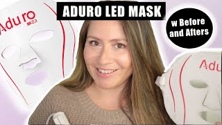 ADURO LED MASK REVIEW W BEFORE AND AFTERS [upl. by Atteiram]