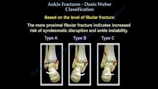 Ankle Fractures Danis Weber Classification  Everything You Need To Know  Dr Nabil Ebraheim [upl. by Wystand]