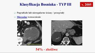 A Cieszanowski  Torbiele nerek – klasyfikacja Bosniaka [upl. by Glenda393]