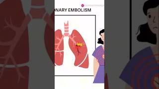 Pulmonary Embolism Explained What Every Med Student Needs to Know PulmonaryEmbolism medstudent [upl. by Maurreen149]