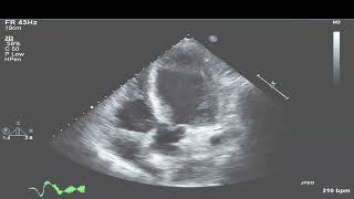 TTE  Acute proximal LAD infarct Example 1 [upl. by Berni280]