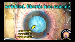 how do you perform a capsulorhexis in a wrinkled fibrotic lens capsule [upl. by Fiske]