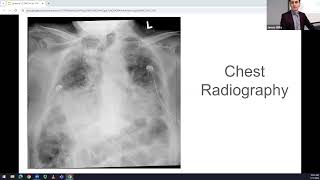 Dr Lavadera  EMCCM  Interstitial Lung Disease [upl. by Grosmark195]