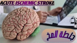 جلطة المخ  acute ischemic stroke CVS CVA STROKE HEMORHAGIC STROKE ISCHEMIC STROKE [upl. by Hyde612]